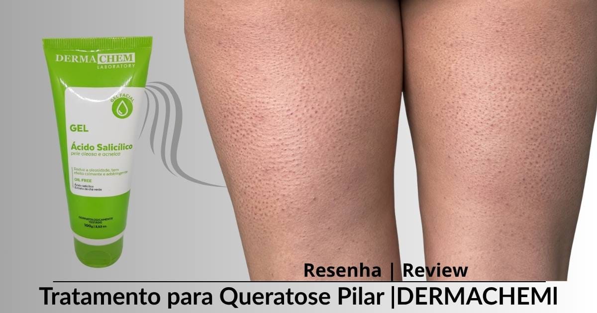 Queratose Pilar e Acne: O Guia Definitivo com o Gel de Ácido Salicílico da Dermachem