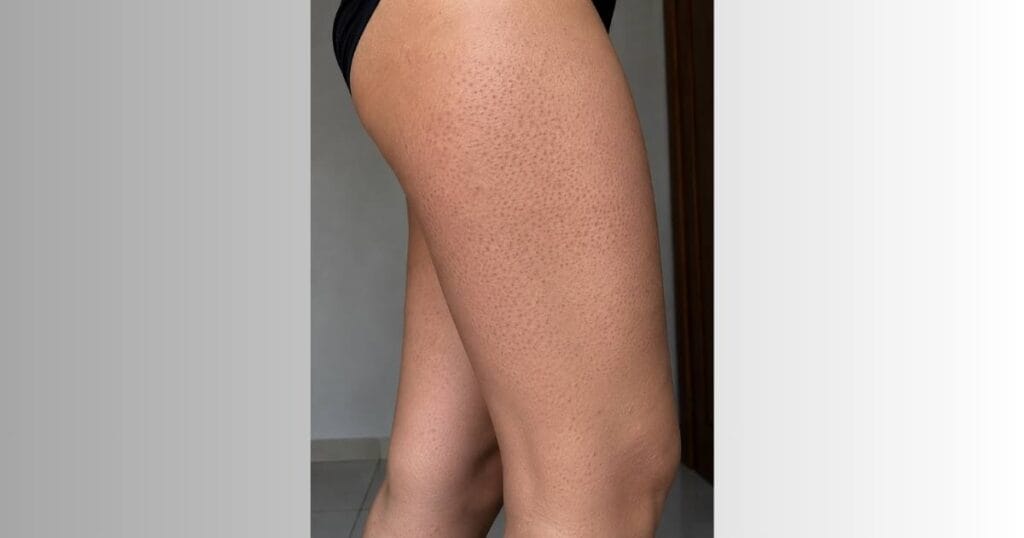 lateral das coxas com queratose pilar resenha