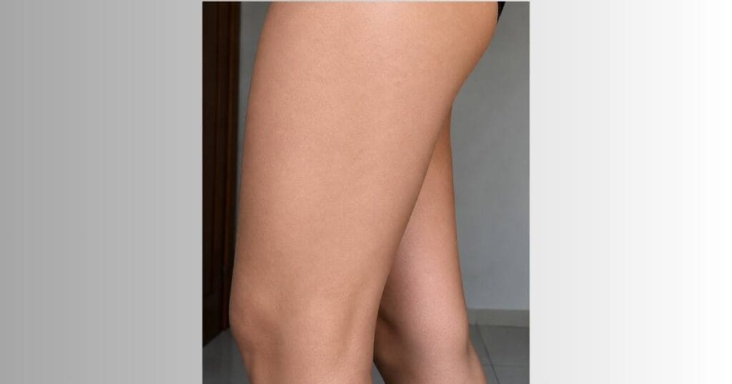 Pós tratamento com Dermachem 