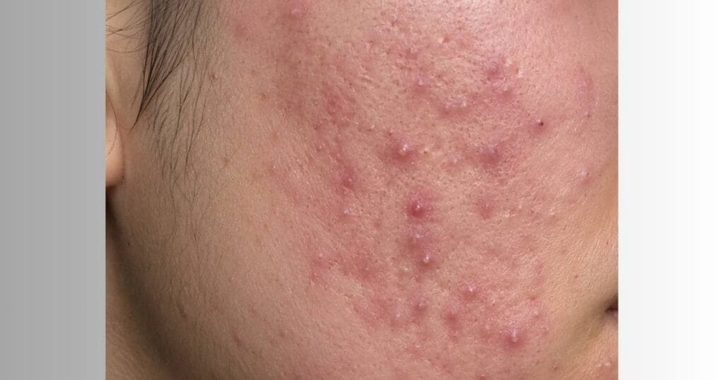 acne inflamada antes do tratamento com dermachem