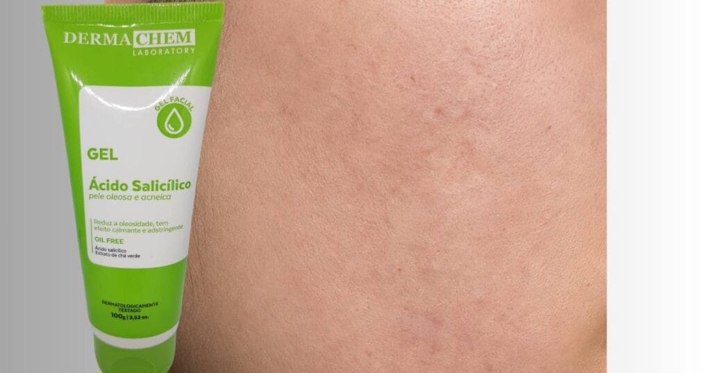 tratamento pós acne com dermachem