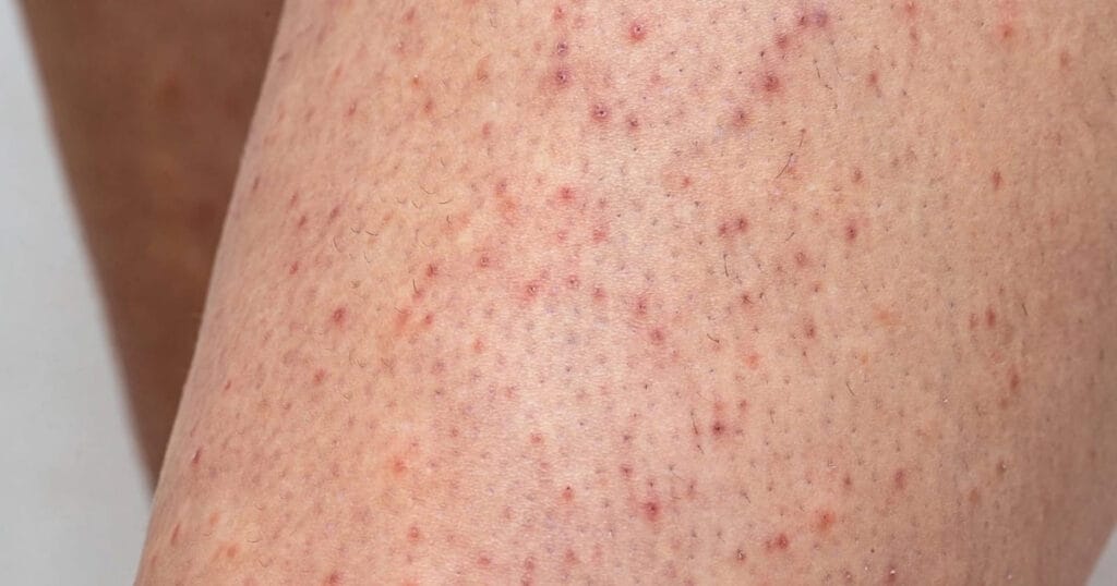 Pele da minha perna com queratose pilar