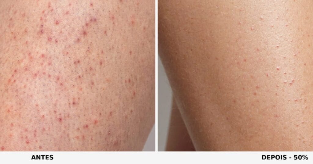 Antes e depois da Queratose Pilar